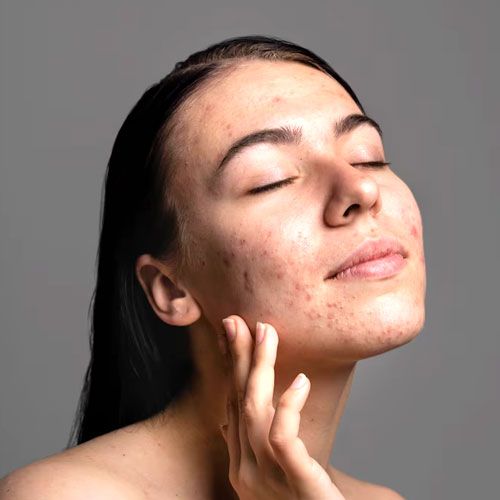 Acne and Acne Scar Care