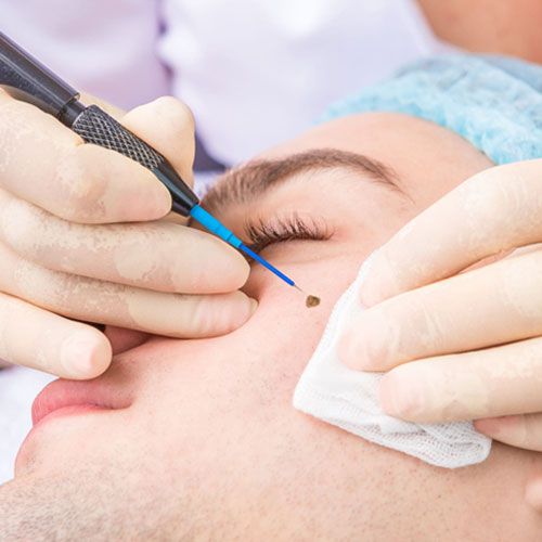 Electrocautery & Radiofrequency Procedures