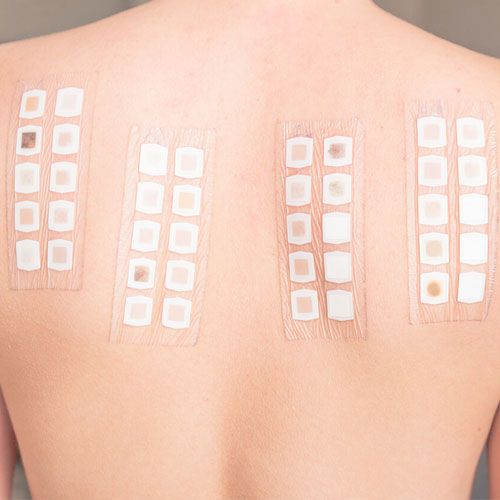 Patch Testing for Contact Allergens